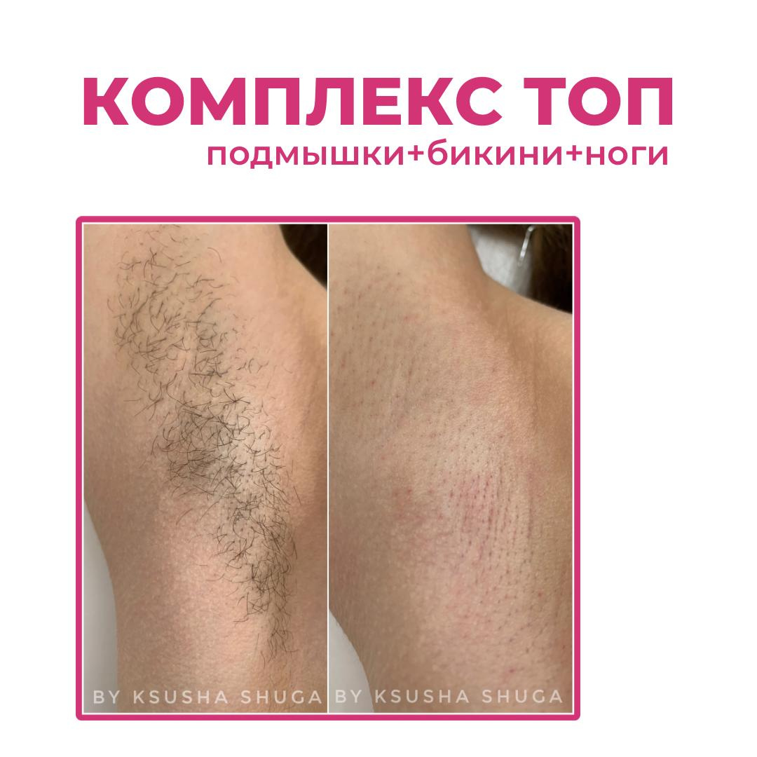 Комплекс ТОП (бикини+подмышки+ноги)
