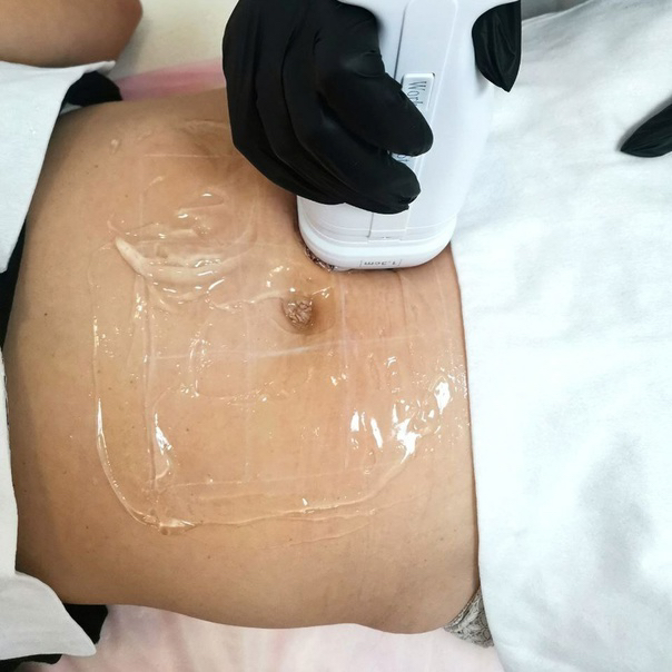 Liposonix живот